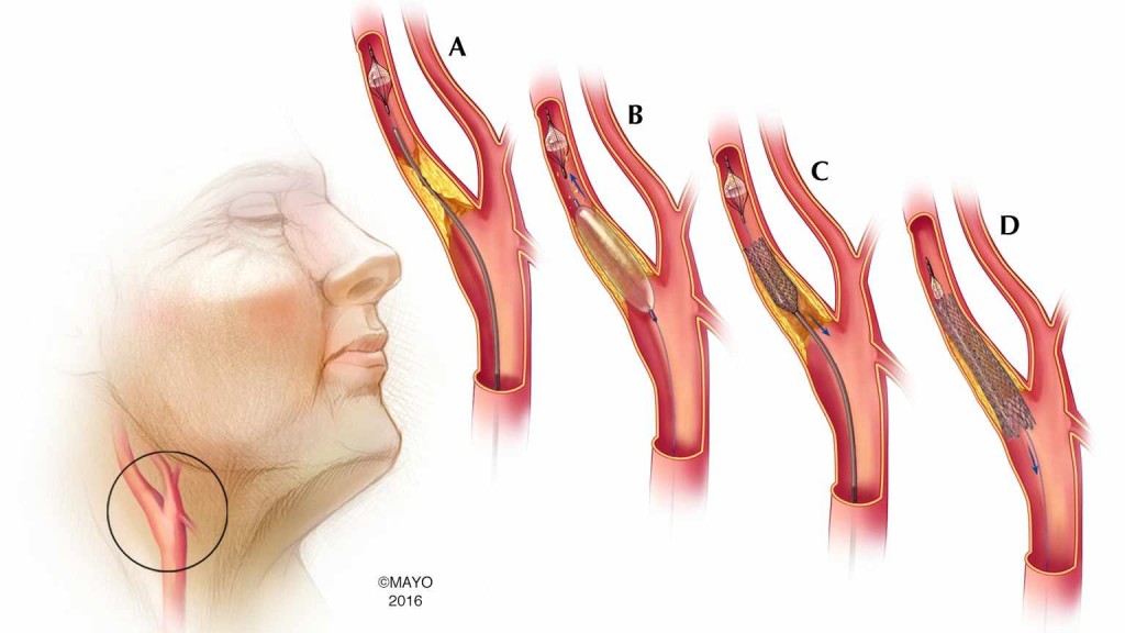 Ilustración médica de la colocación del estent en la arteria carótida