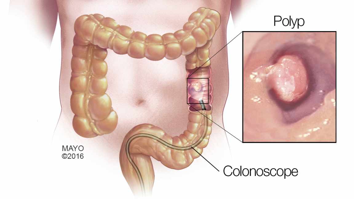 Ilustración médica del colon, los pólipos y el colonoscopio