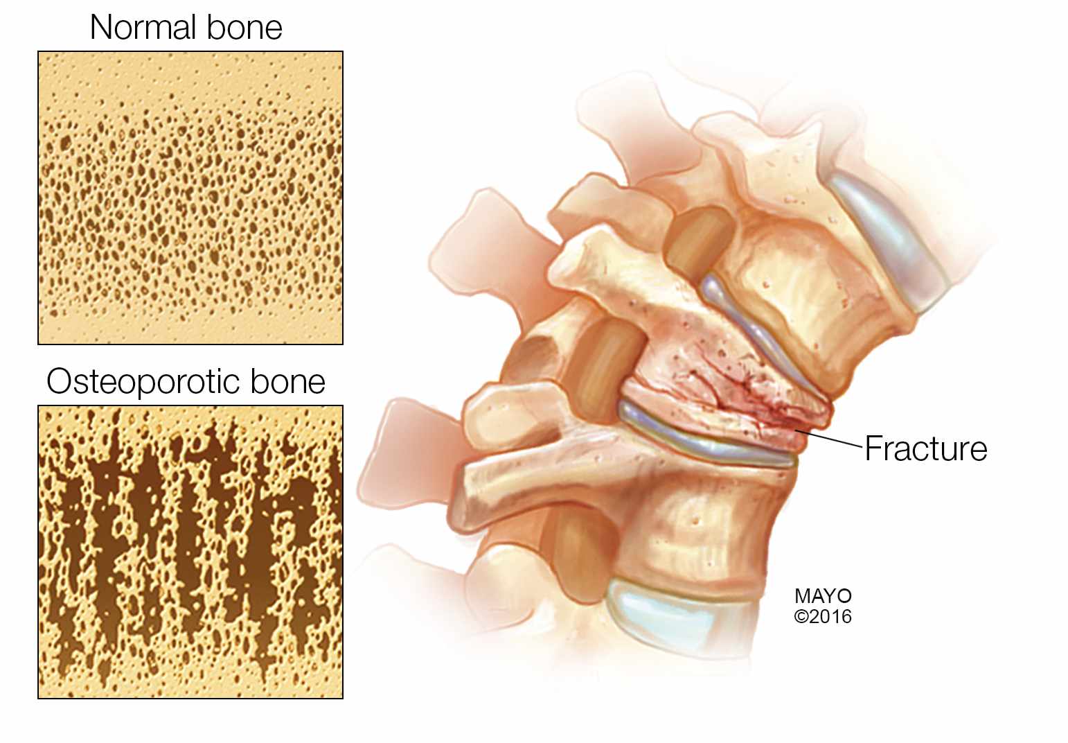 Ilustración médica de un hueso fracturado y un hueso normal, arriba, y de un hueso con osteoporosis, abajo