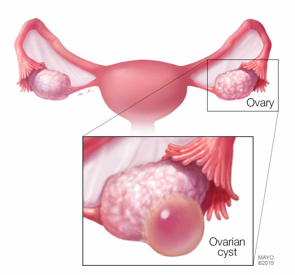 medical illustration of ovaries and an ovarian cyst