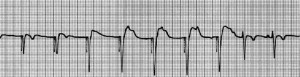 #ThrowbackThursday 1982: PACEMAKER Testing Brings Calls From Around The ...