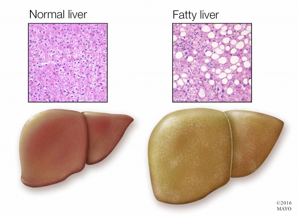medical illustration of normal liver and fatty liver