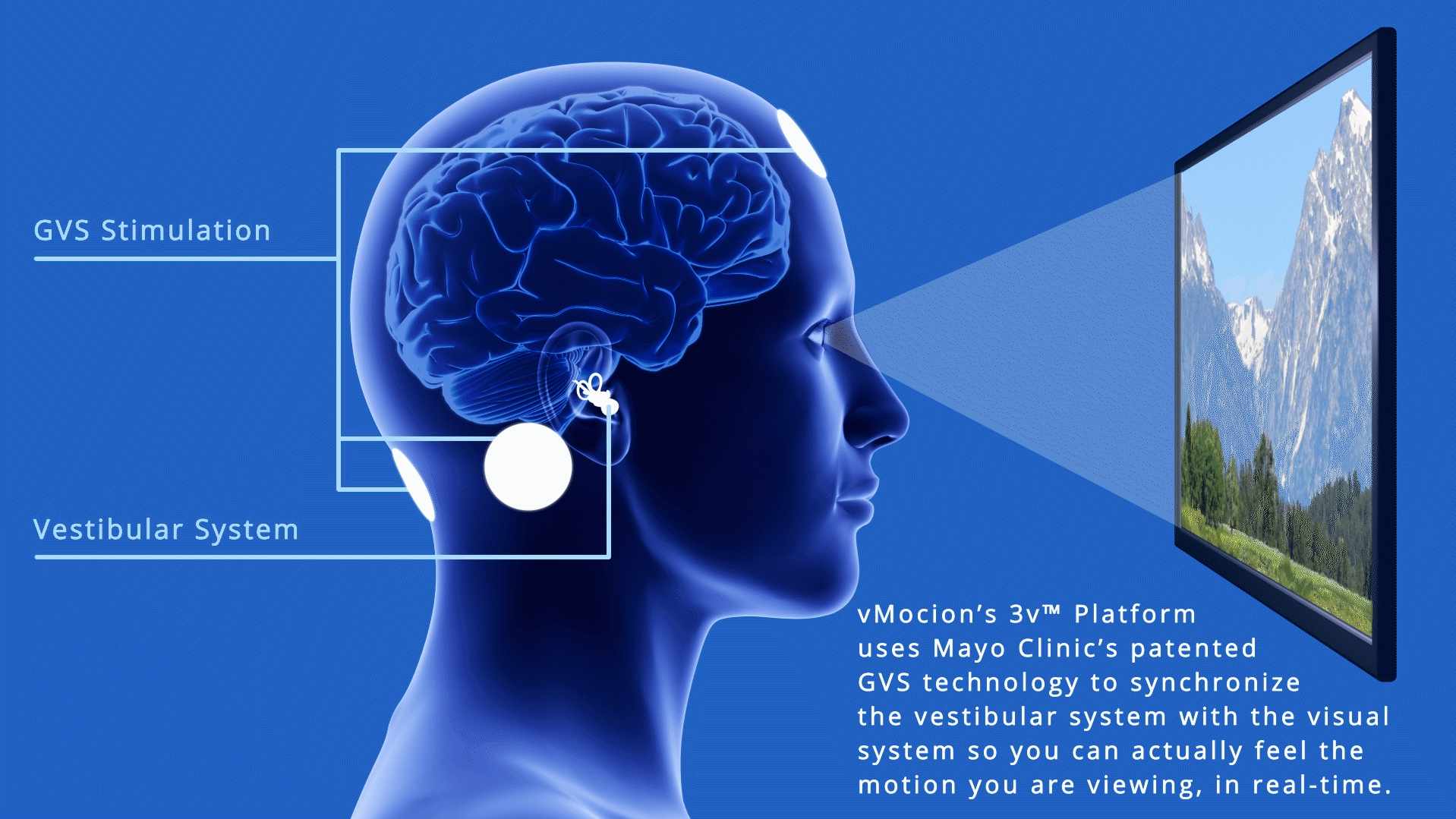 Illustration of vMocion 3v Platform attached to human brain