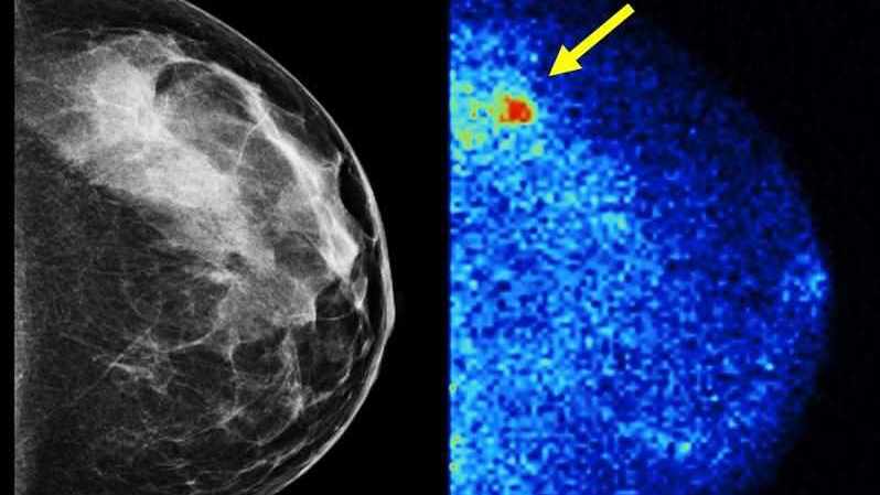molecular breast image and mammogram side by side