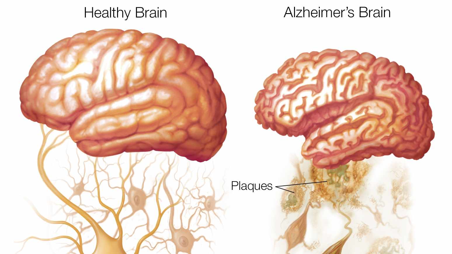 Illustration of a healthy brain and Alzheimer's brain