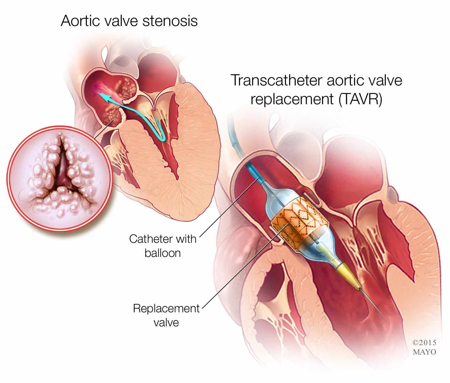 Ilustración médica de la estenosis de la válvula aórtica y del reemplazo transcatéter de la válvula aórtica (TAVR, por sus siglas en inglés)