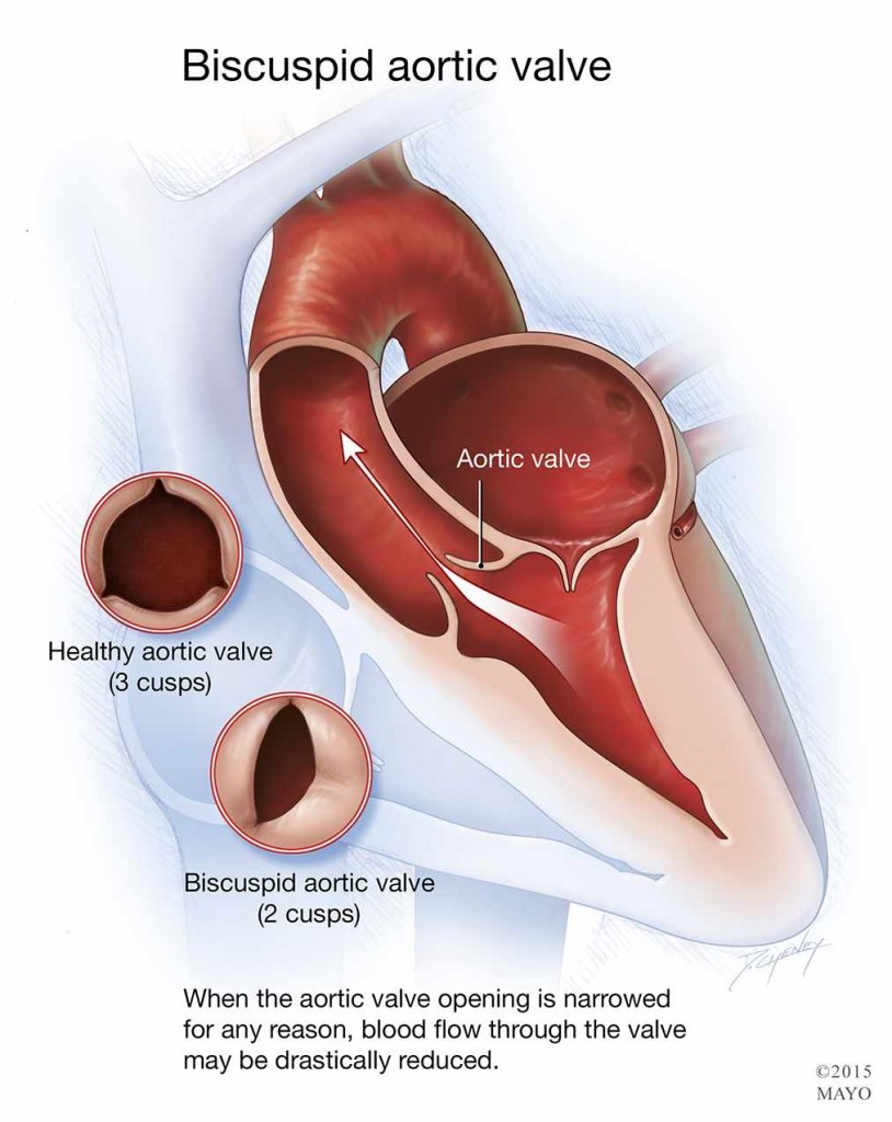 medical illustration of bicuspid aortic valve