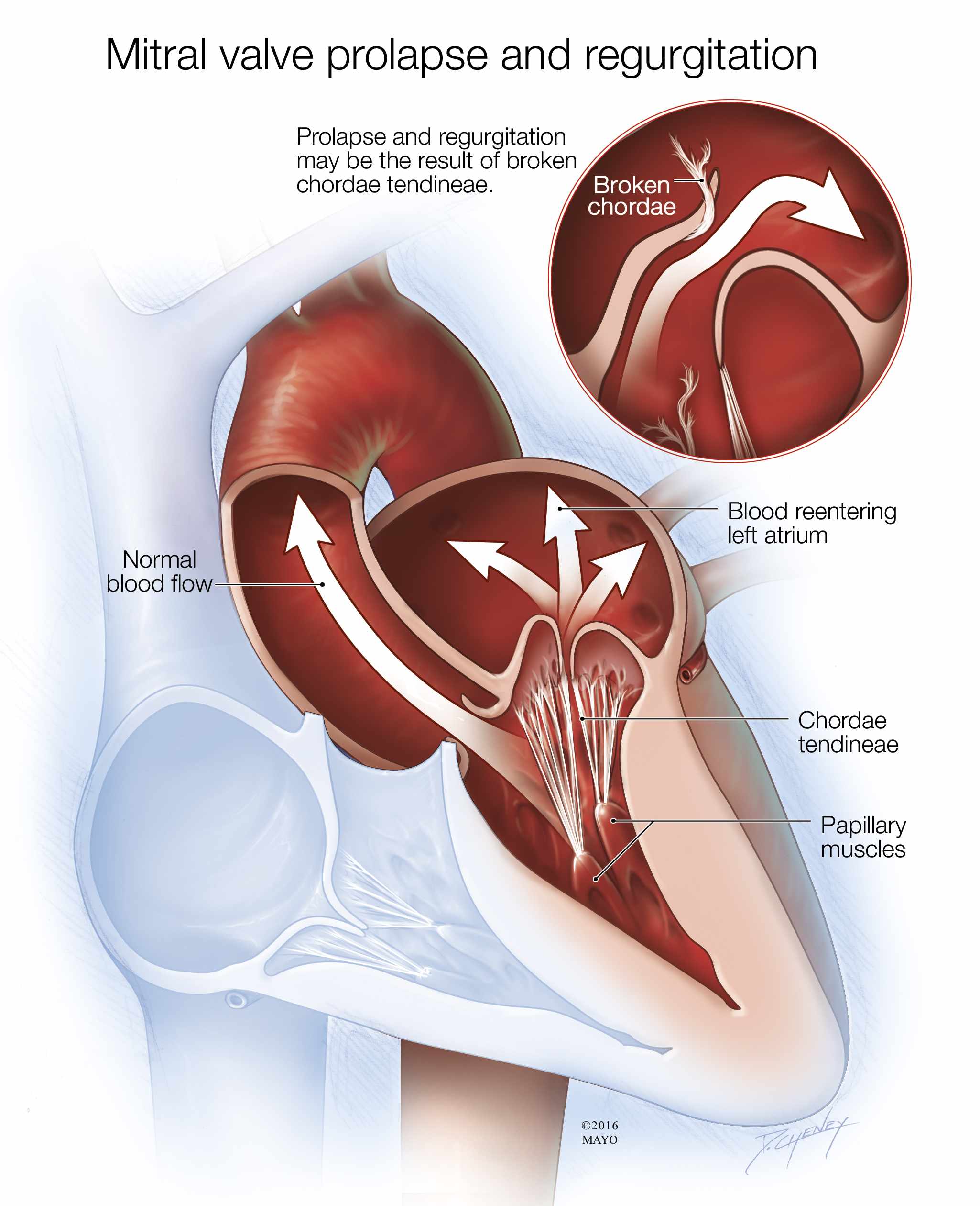Ilustración médica del prolapso y la regurgitación de la válvula mitral
