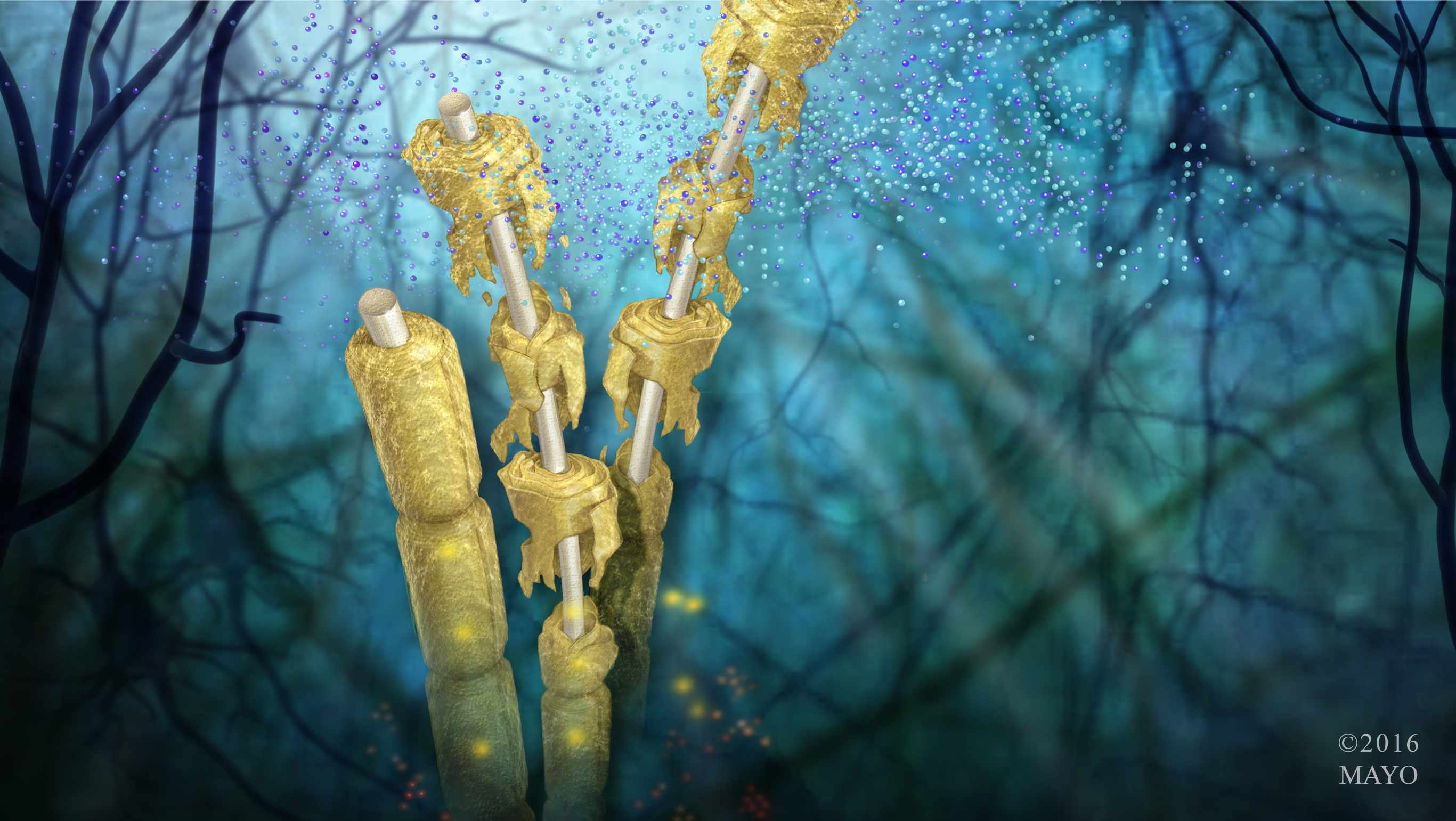 Ilustración del daño de desintegración sufrido por la vaina de mielina que recubre las fibras nerviosas