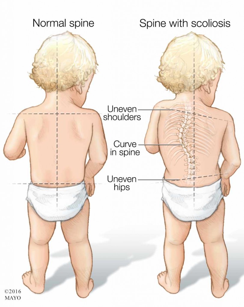 a medical illustration of a child with a normal spine and one with scoliosis