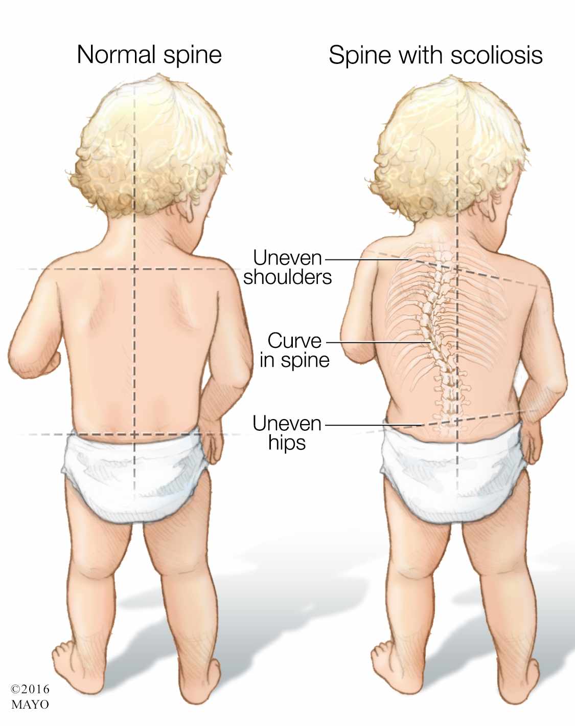 Ilustración médica de un niño con columna vertebral normal y de otro con escoliosis