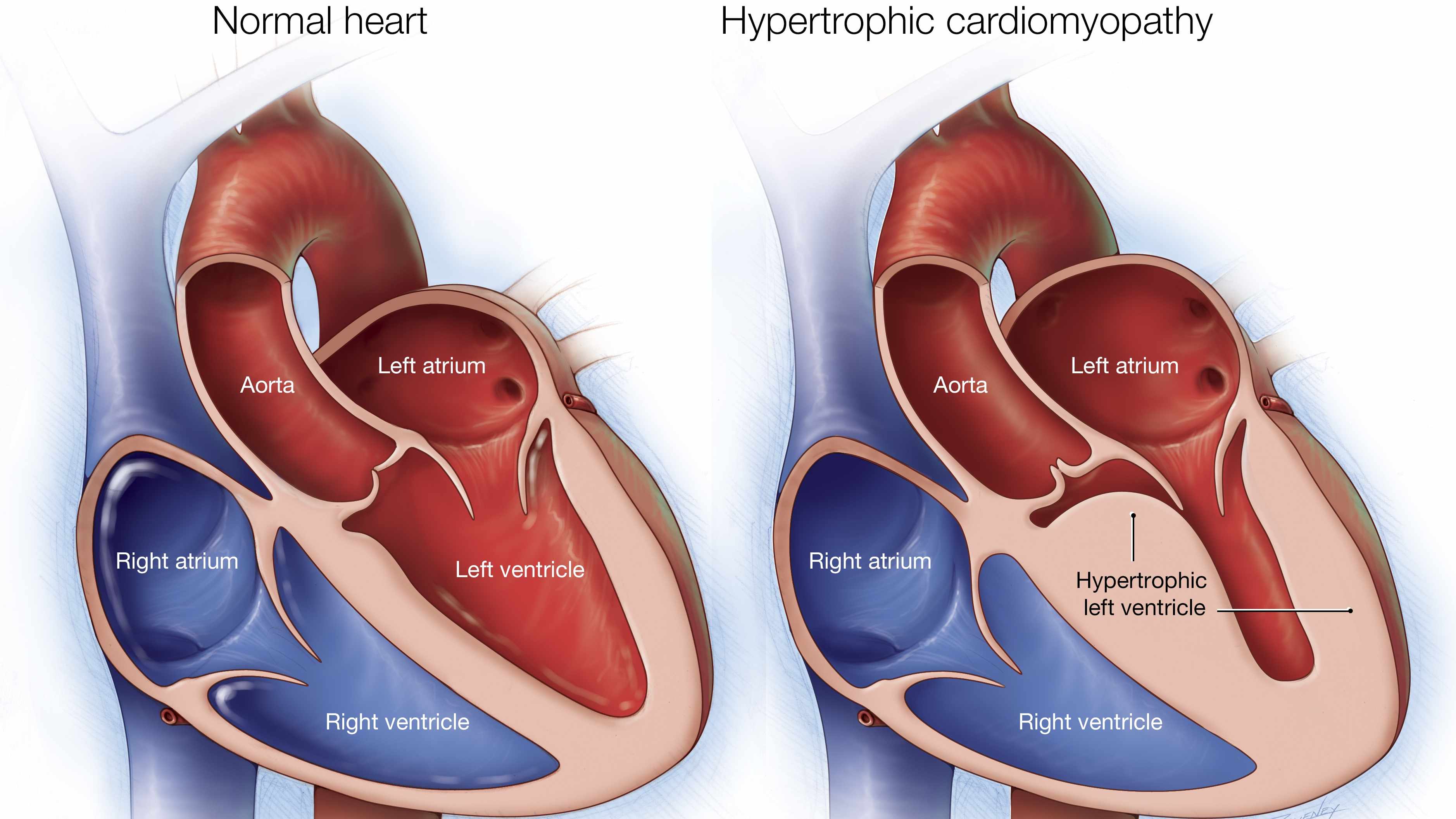 lustración médica de un corazón normal (izquierda) y de otro con miocardiopatía hipertrófica (derecha)