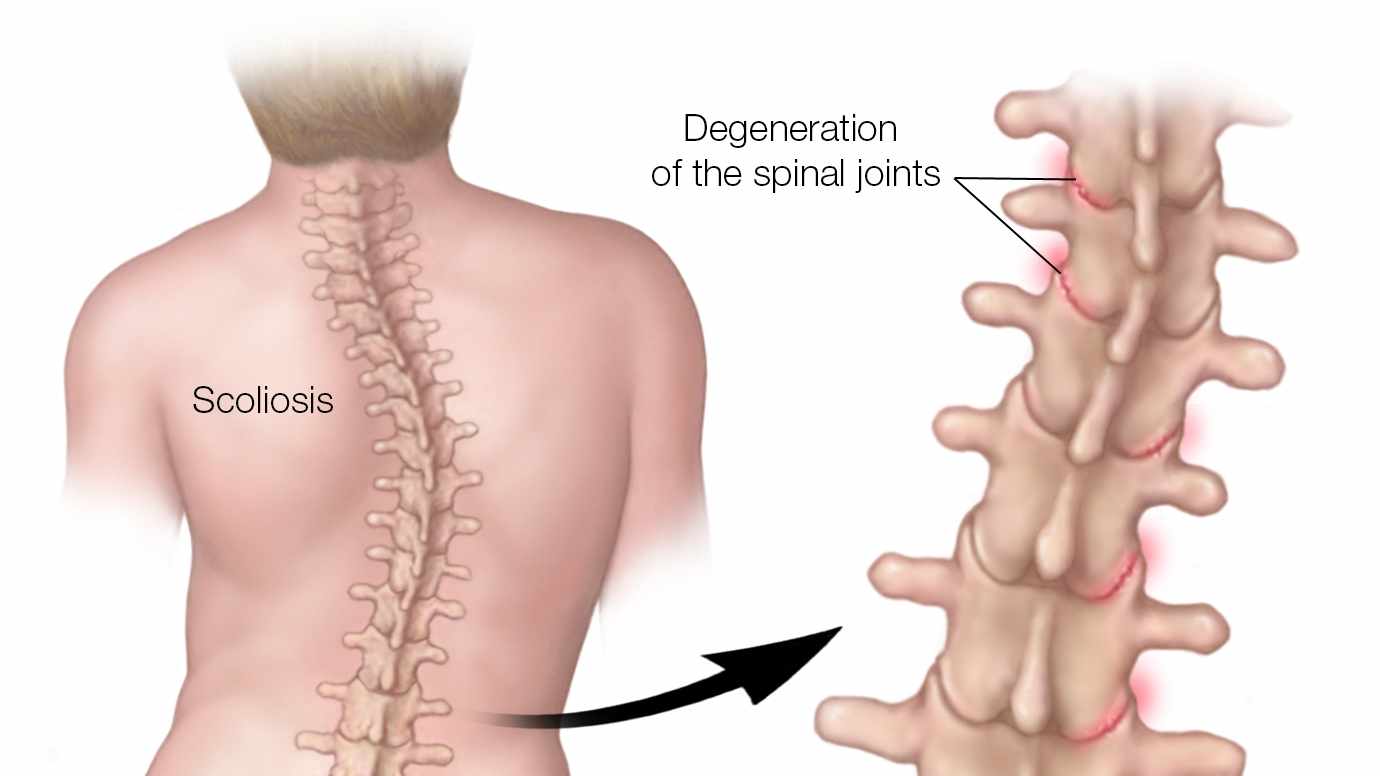 Ilustración médica de una columna con escoliosis donde se resalta la degeneración de las articulaciones de la columna vertebral