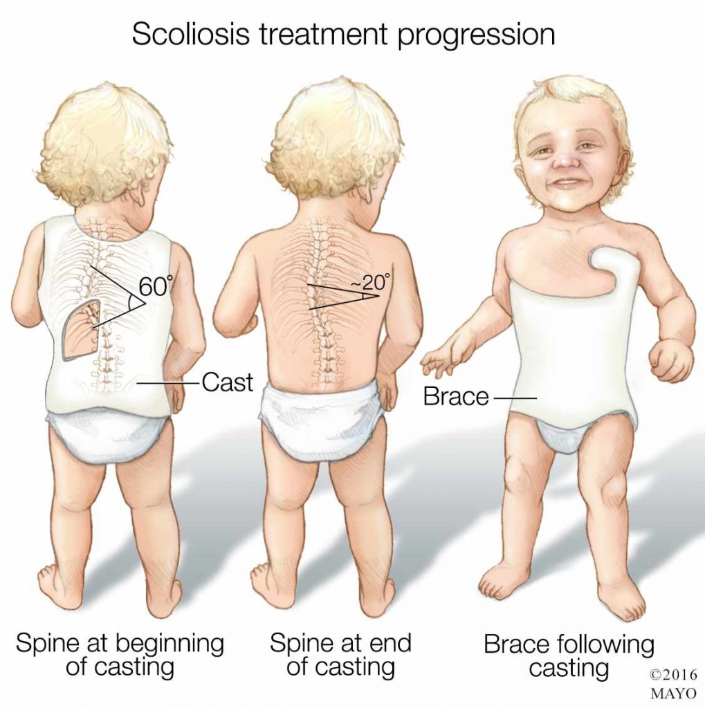a medical illustration of scoliosis treatment progression in a child