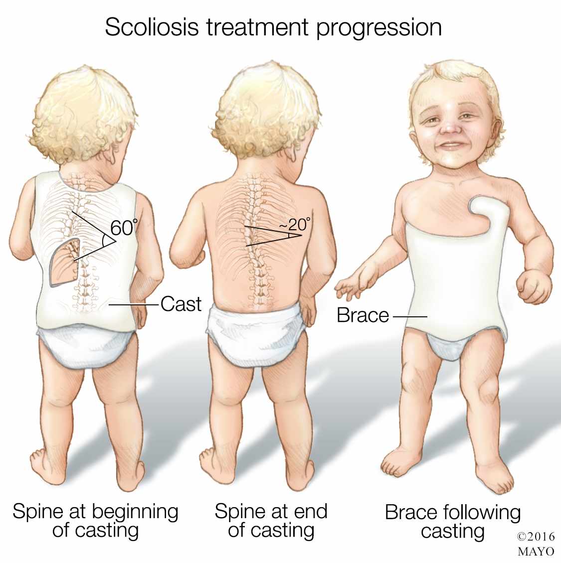 Ilustración médica del progreso del tratamiento de la escoliosis en un niño