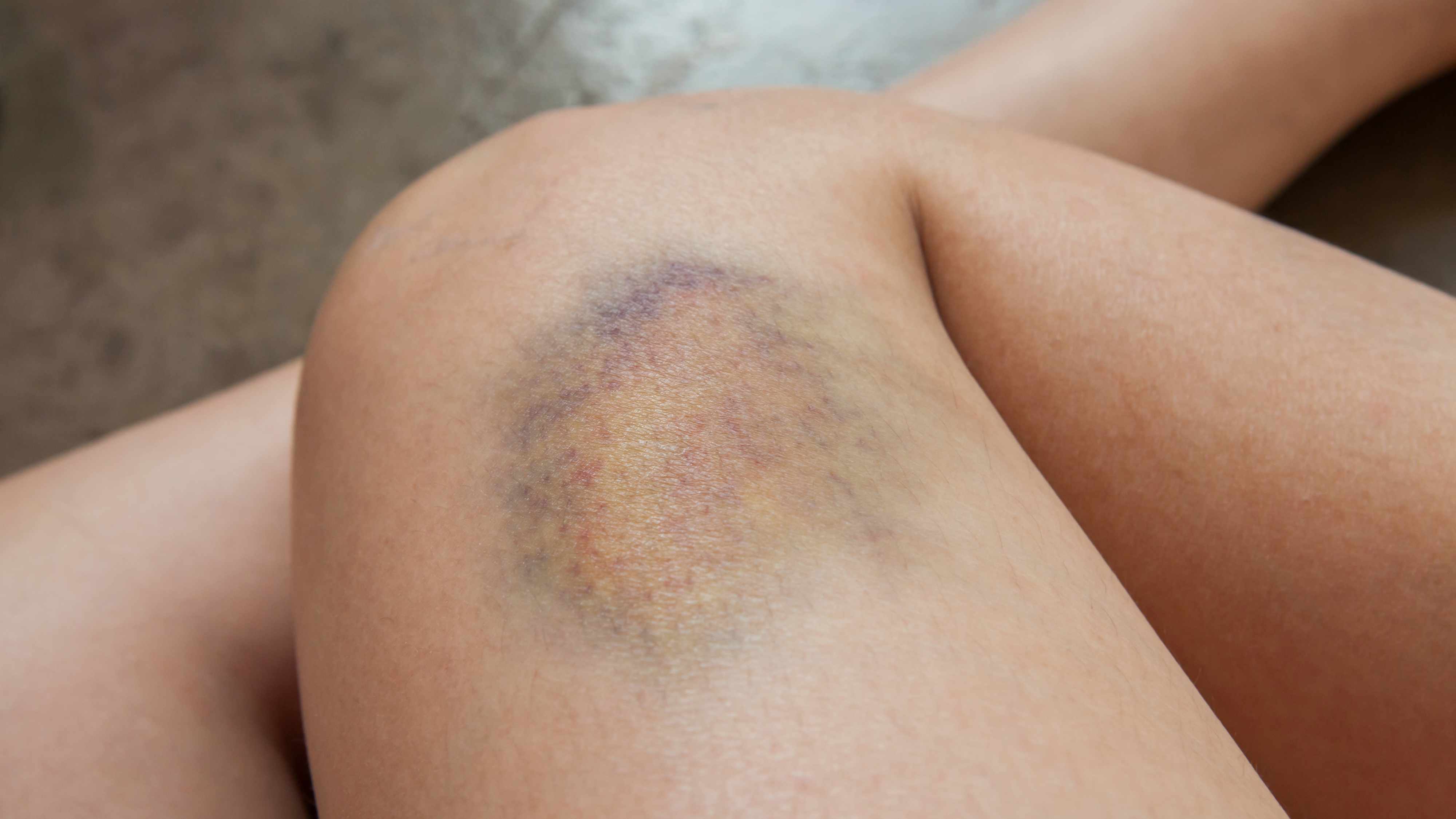 a person's leg with a large yellow, green and purple bruise