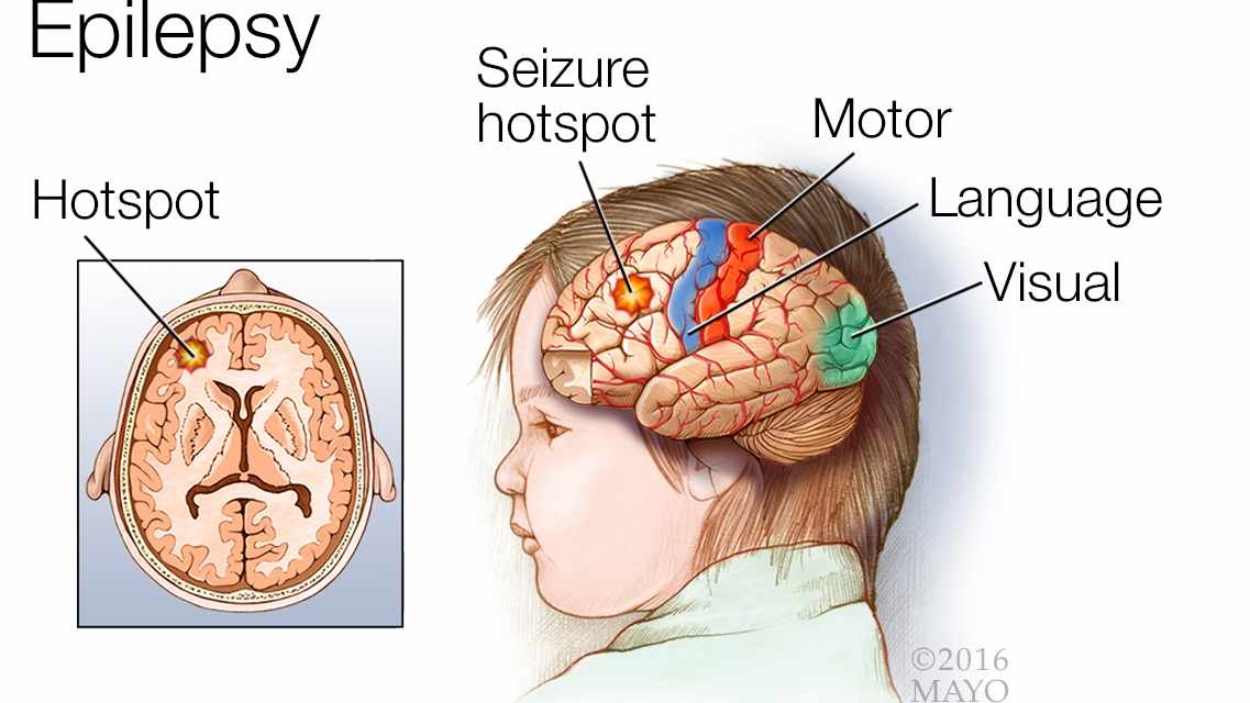 ilustración médica de un cerebro con epilepsia, de un punto álgido de convulsiones y de las áreas motora, del lenguaje y de la visión