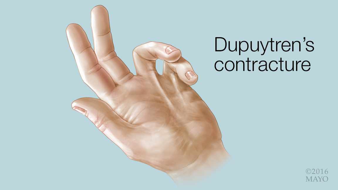 https://newsnetwork.mayoclinic.org/n7-mcnn/7bcc9724adf7b803/uploads/2016/04/medical-illustration-of-a-hand-with-Dupuytren%E2%80%99s-contracture-16X9.jpg