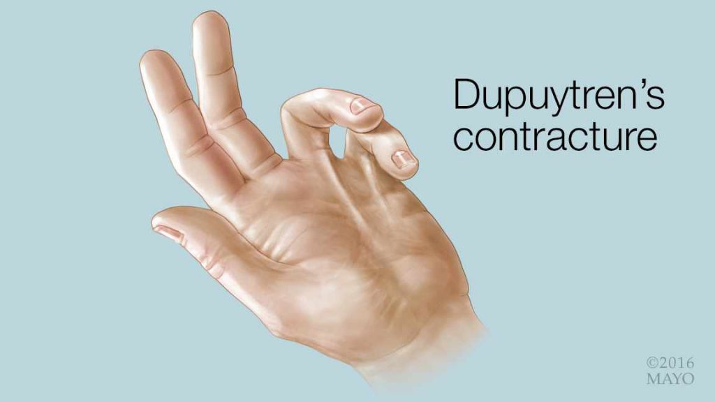 medical illustration of a hand with Dupuytren’s contracture