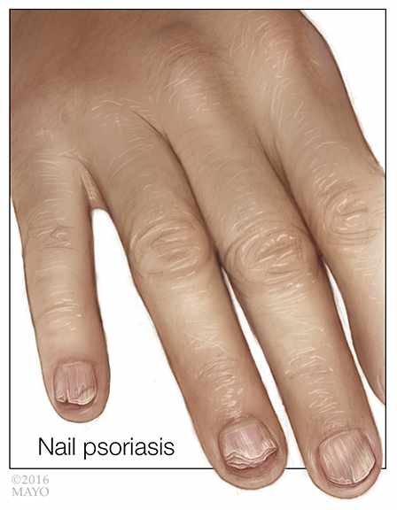 medical illustration of fingernail psoriasis_72 (original)