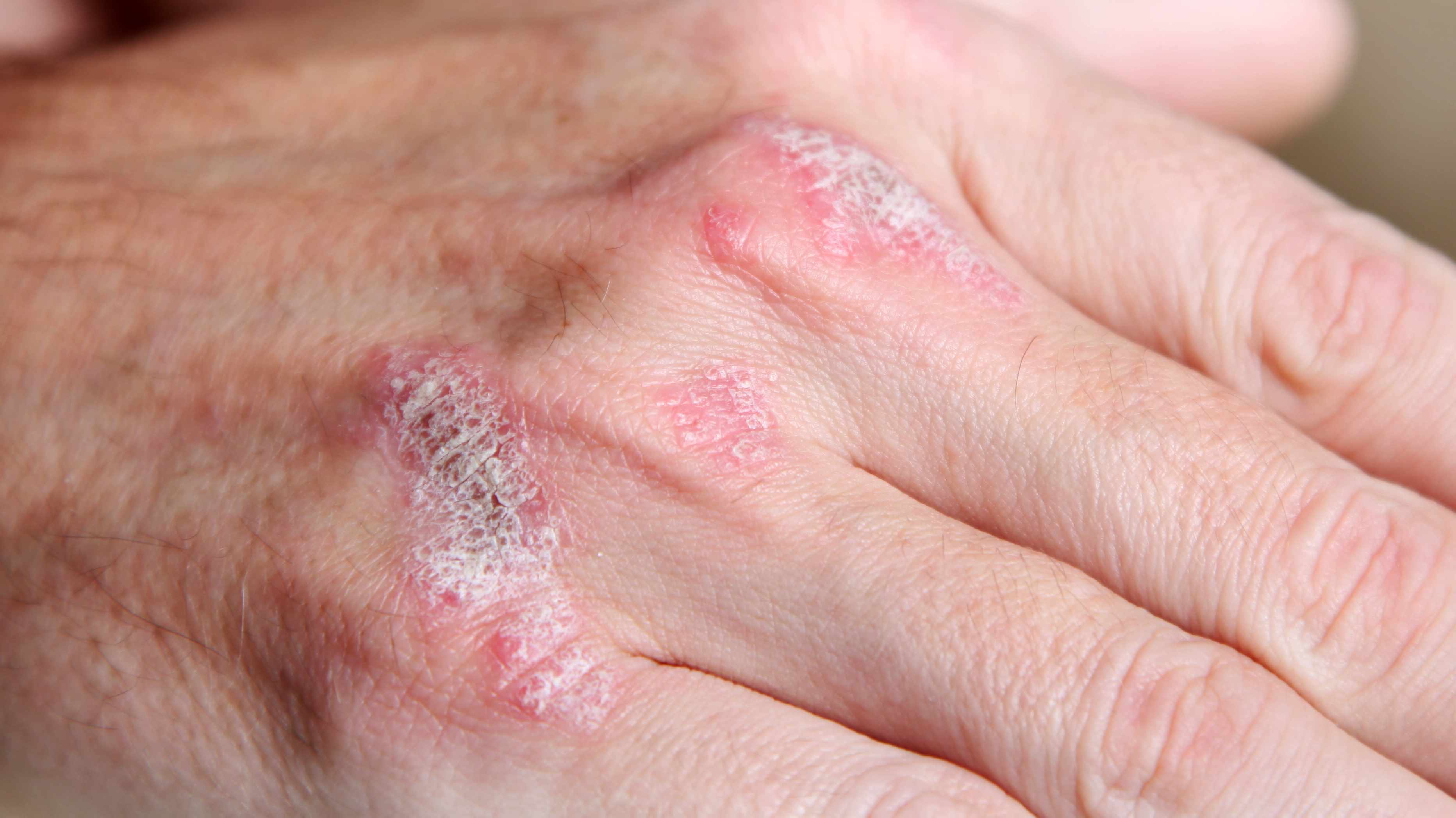 Psoriasis en la mano de una persona, con enrojecimiento, inflamación, sequedad e irritación.