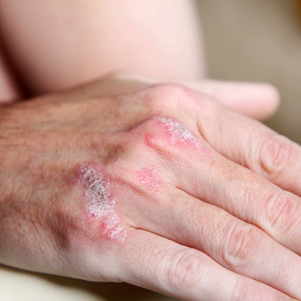 psoriasis on a person's hand, red, inflamed, dry and sore