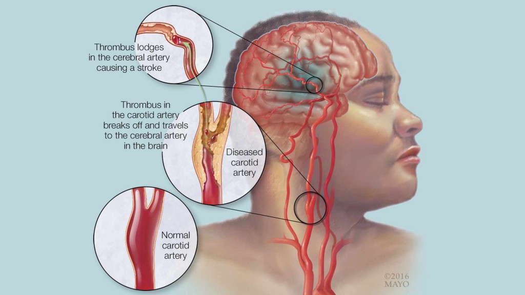 medical illustration depicting stroke