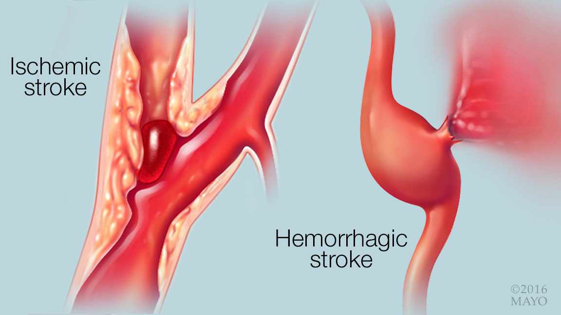 medical illustration showing ischemic and hemorrhagic strokes