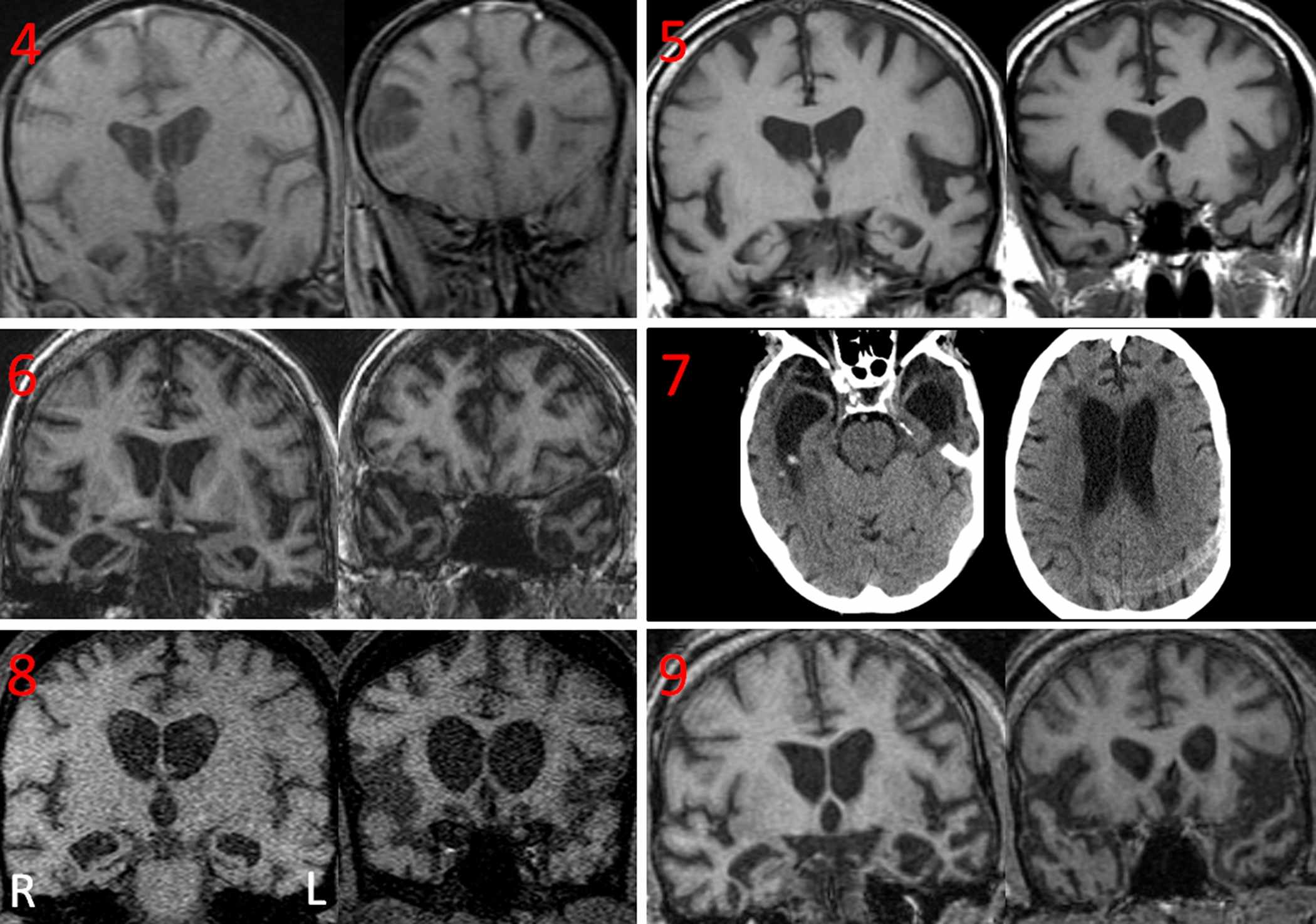Exploraciones por imágenes del cerebro de seis pacientes con demencia que mostraban coprofagia revelaron atrofia o degeneración en la parte media del lóbulo temporal