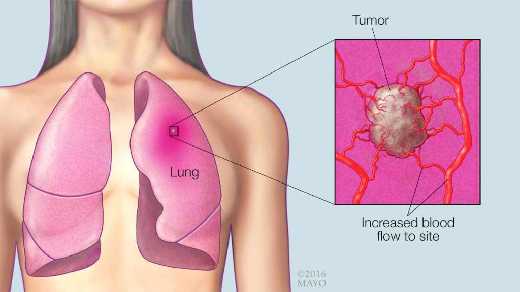 a medical illustration of lungs, a lung cancer tumor and increased blood flow to the site