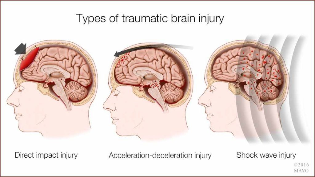 a medical illustration of types of traumatic brain injury