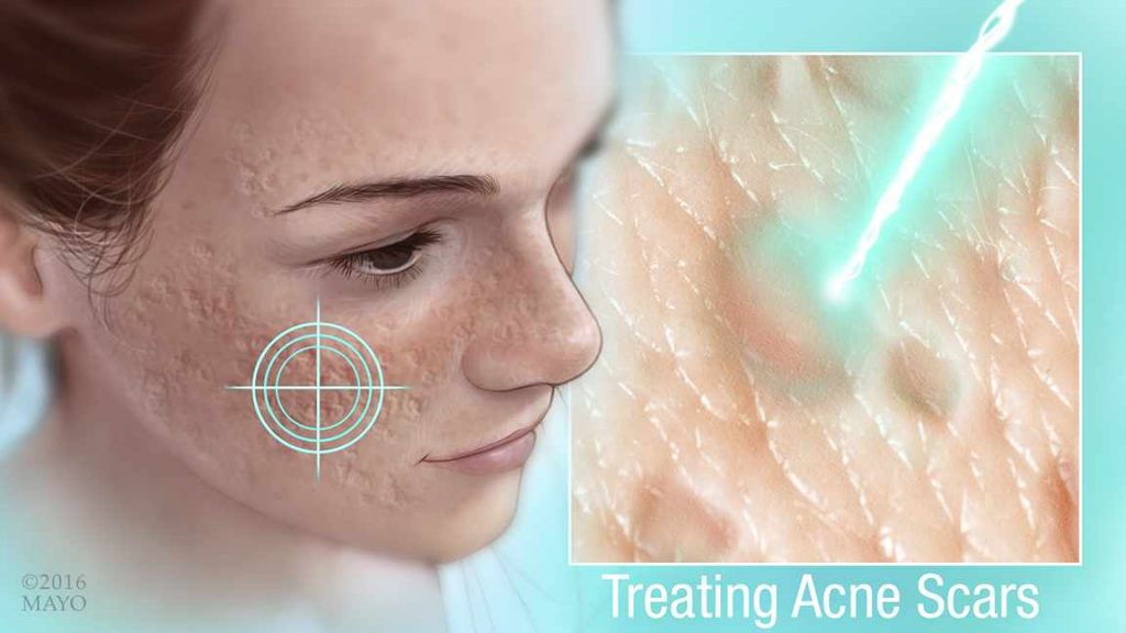 Ilustración médica que muestra las cicatrices del acné