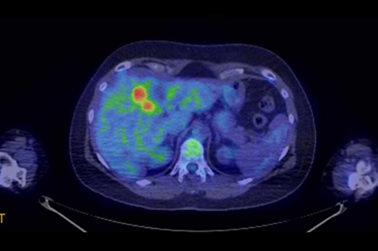 radiological image of liver cancer