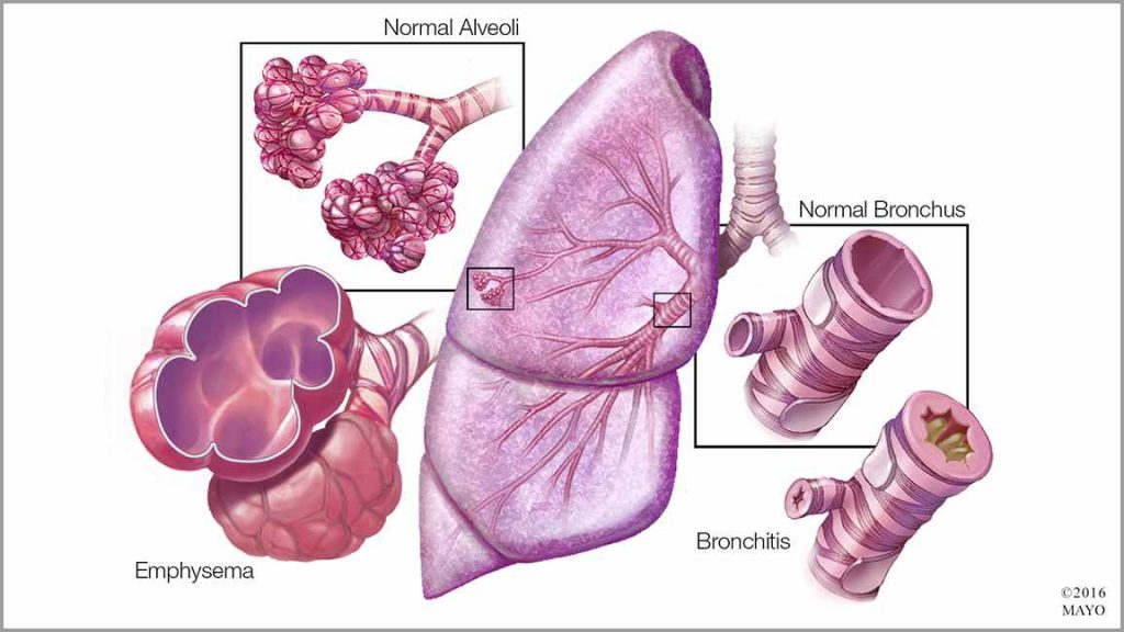 medical illustration showing a lung, normal alveoli, emphysema, normal bronchus, and bronchitis