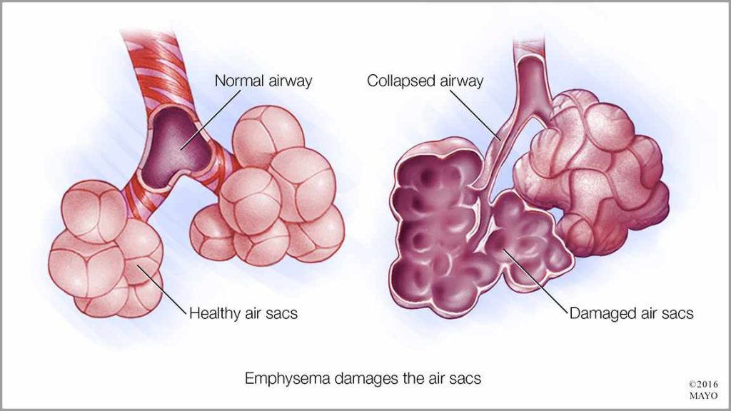 Ilustración médica de alvéolos sanos y vías respiratorias normales (izquierda) y de alvéolos dañados y vías respiratorias con enfisema (derecha)