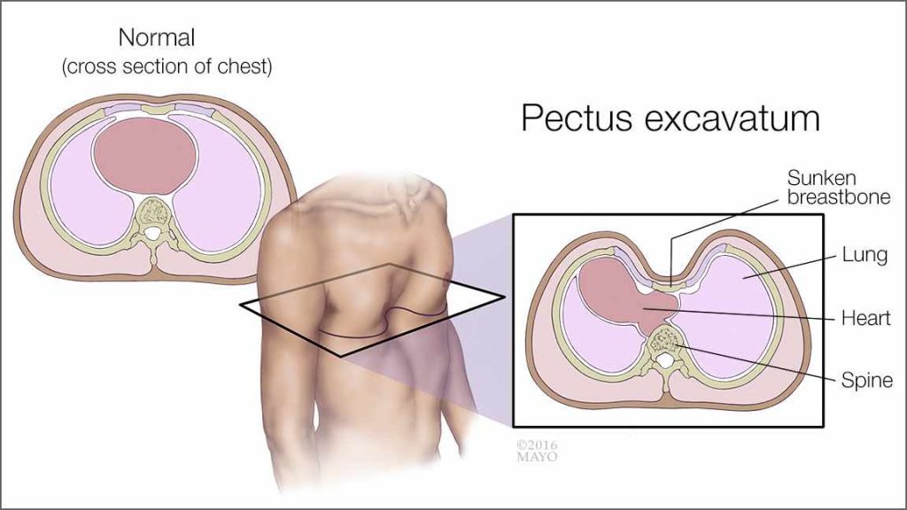 Illustration of pectus excavatum and normal chest