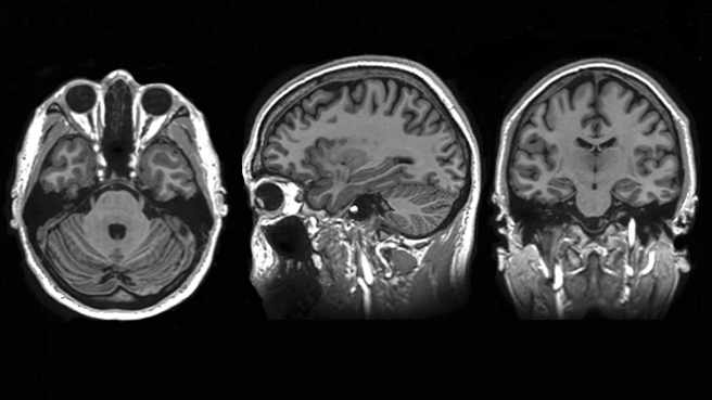 MRI Scan of brain