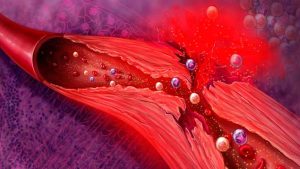 Mayo Clinic Minute: How vasculitis affects the body - Mayo Clinic News ...