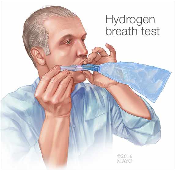 Ilustración médica de la prueba de hidrógeno en el aliento para diagnosticar la intolerancia a la lactosa