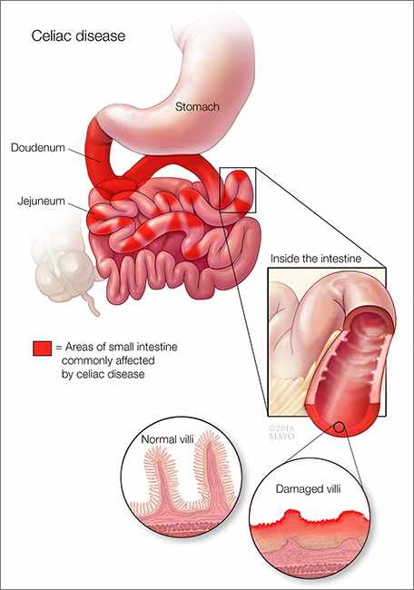 Ilustración médica de la enfermedad celíaca