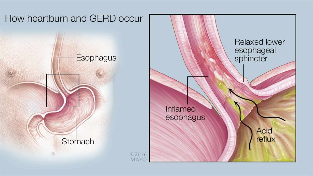 a medical illustration of how heartburn and GERD occur