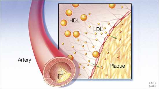 Ilustración médica de los efectos del colesterol sobre una arteria 