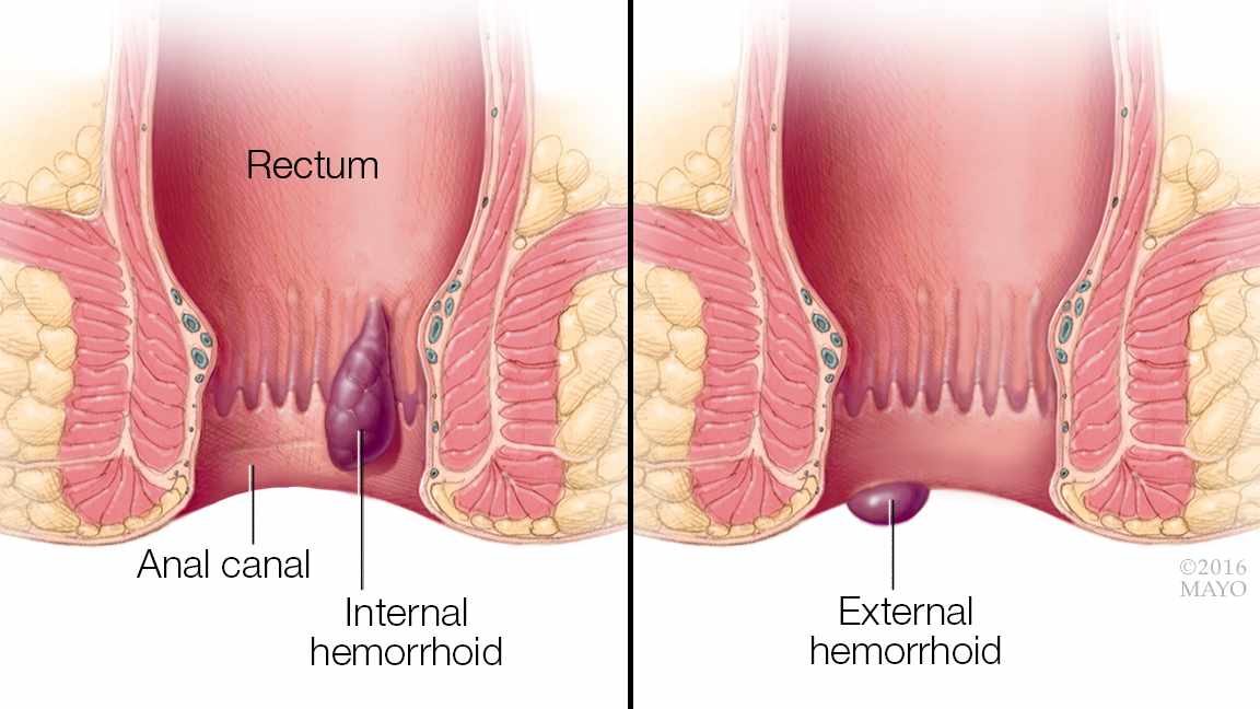 a medical illustration showing internal and external hemorrhoids