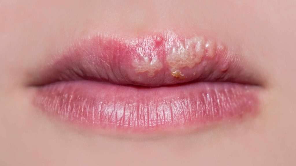 Cómo curar un herpes labial