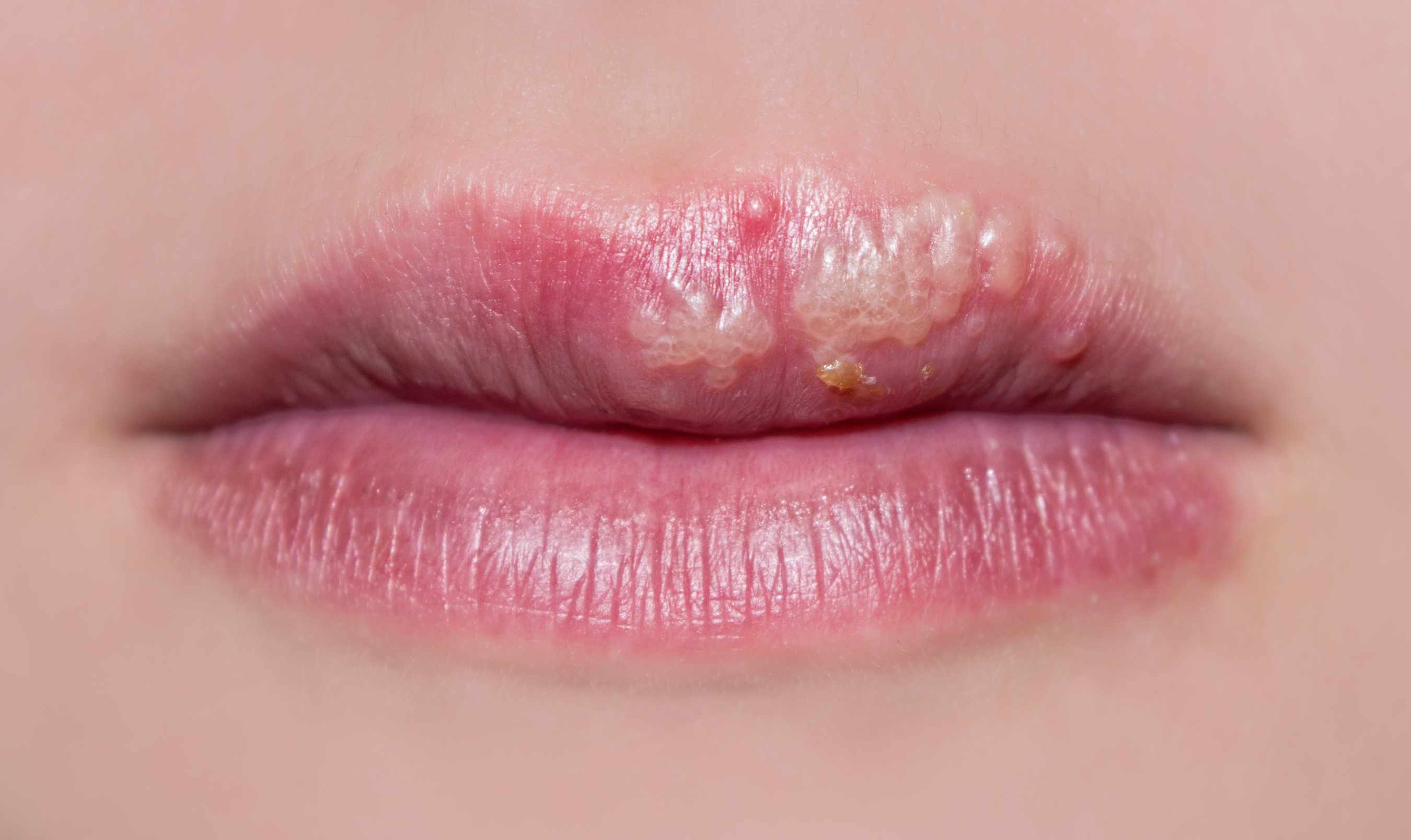 a close-up of a woman's lips with cold sores