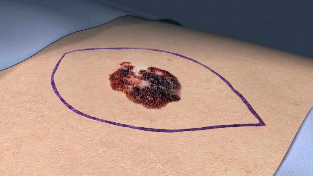 medical illustration of a skin lesion melanoma., a skin cancer