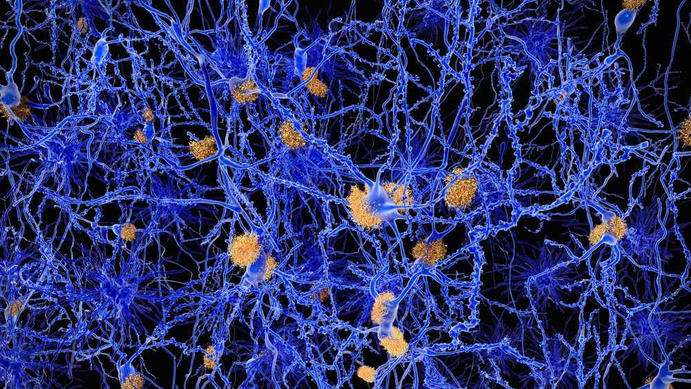 Enfermedad de Alzheimer: red neuronal con placas de amiloides