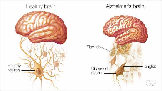 Ilustración médica de un cerebro sano (izquierda) y de otro con la enfermedad de Alzheimer (derecha)