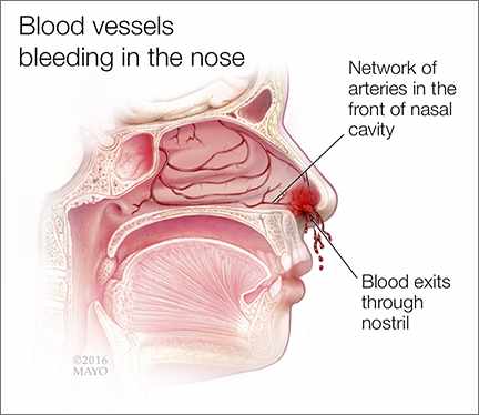 Ilustración médica de un sangrado de la nariz
