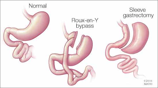 https://newsnetwork.mayoclinic.org/n7-mcnn/7bcc9724adf7b803/uploads/2016/07/a-medical-illustration-of-gastric-bypass-procedures-a-normal-stomach-one-with-a-Roux-en-Y-bypass-and-one-with-a-sleeve-gastrectomy-original.jpg
